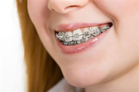 bracket metalicos|bracket dental precio.